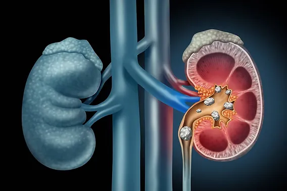 RIRS Retrograde IntraRenal Surgery